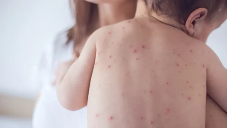 How to Spot Measles Symptoms and Protect Your Family in Gauteng How to Spot Measles Symptoms and Protect Your Family in Gauteng