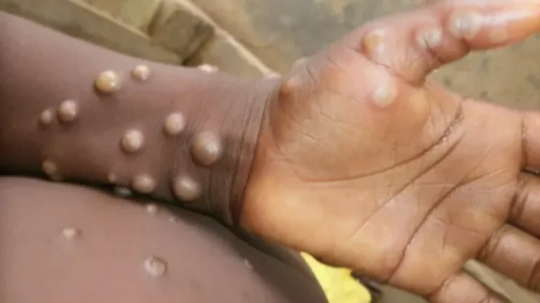 Rising Mpox Infections in South Africa Prompt Health Department Warning Rising Mpox Infections in South Africa Prompt Health Department Warning