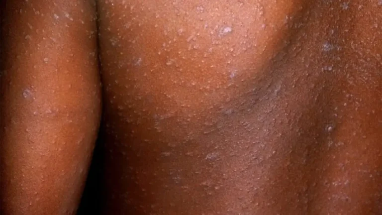 How Schools and Crèches Are Helping Fight Measles Outbreaks in Gauteng How Schools and Crèches Are Helping Fight Measles Outbreaks in Gauteng