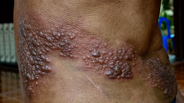 Shingles: Recognizing the Symptoms Shingles: Recognizing the Symptoms