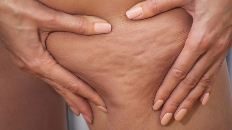 How to Reduce Cellulite According to Experts How to Reduce Cellulite According to Experts